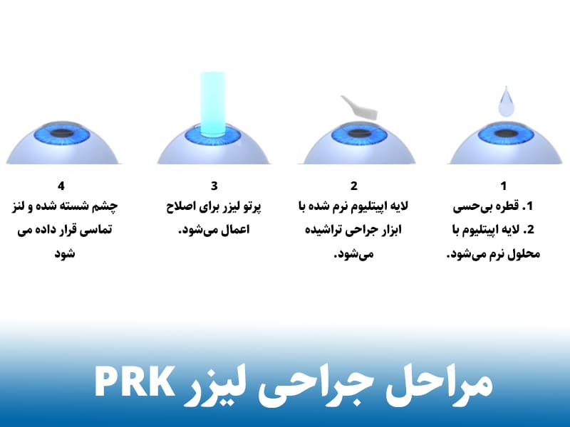 مراجل جراحی عمل prk