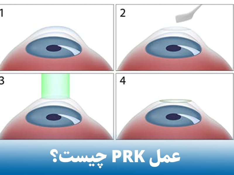 عمل پی آر کی prk چیست؟