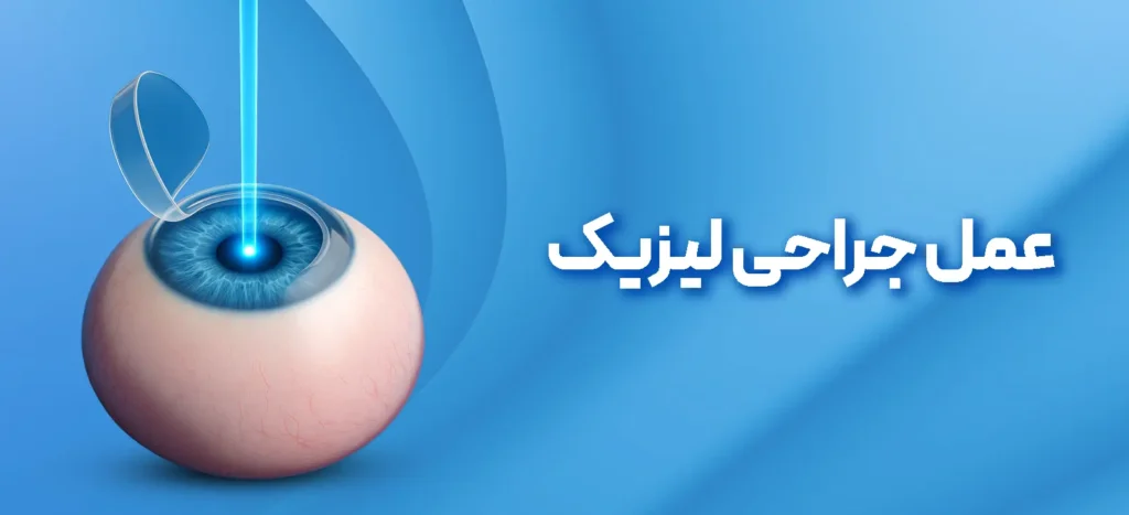 عمل لیزیک چشم
