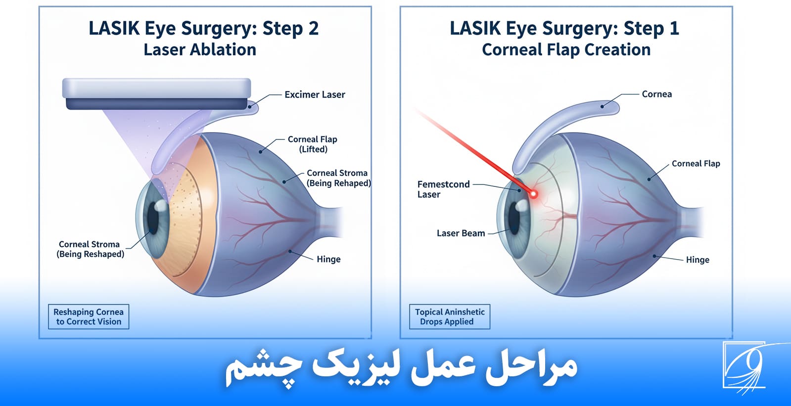 مراحل-عمل-لیزیک-چشم