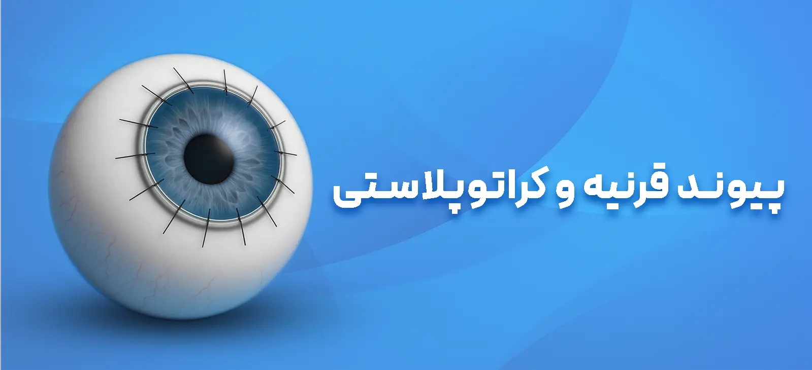 پیوند قرنیه چیست