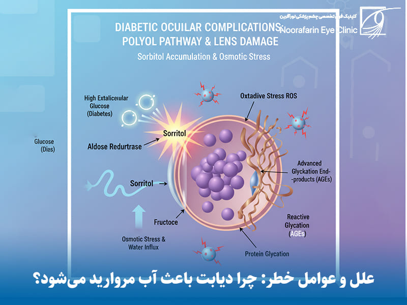 علل و عوامل خطر: چرا دیابت باعث آب مروارید میشود؟