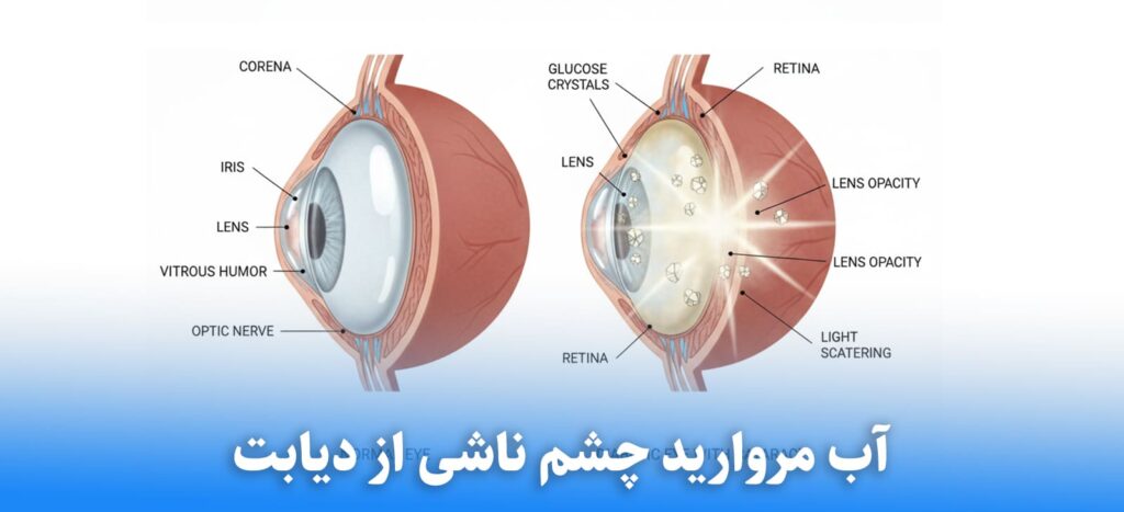 آب مروارید چشم ناشی از دیابت