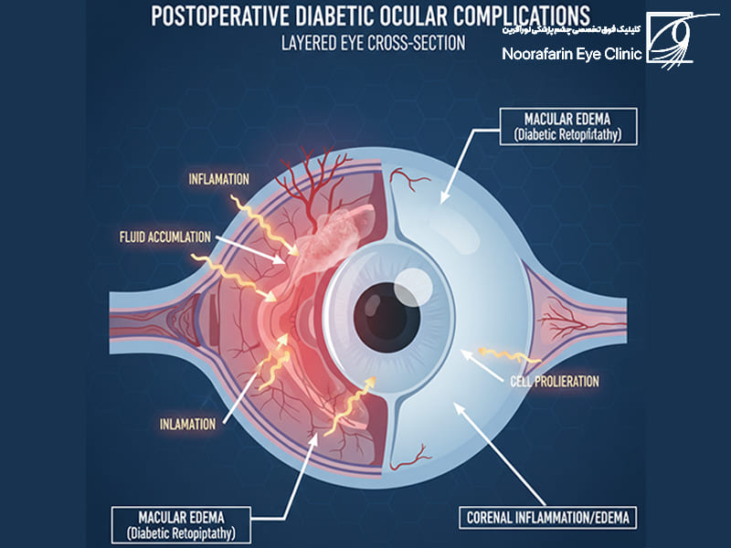 عوارض عمل آب مروارید در دیابتیها