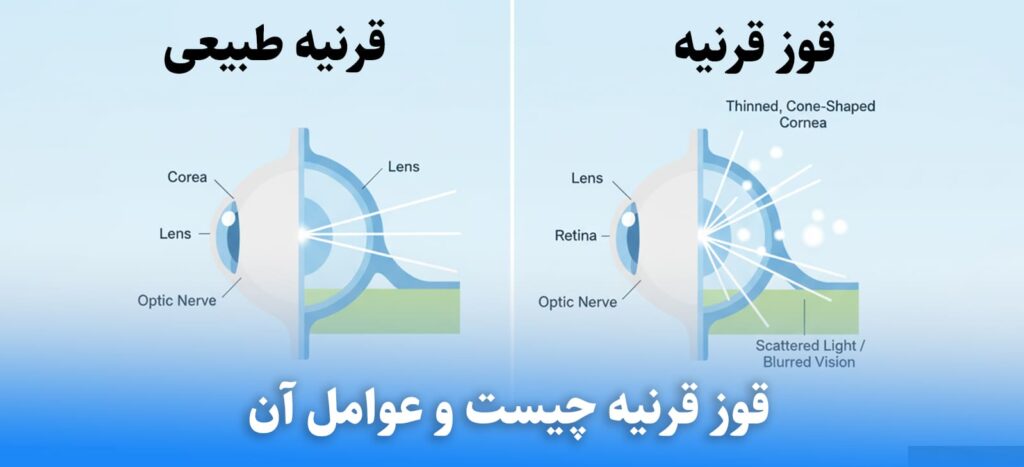 چه چیزی باعث قوز قرنیه می شود؟