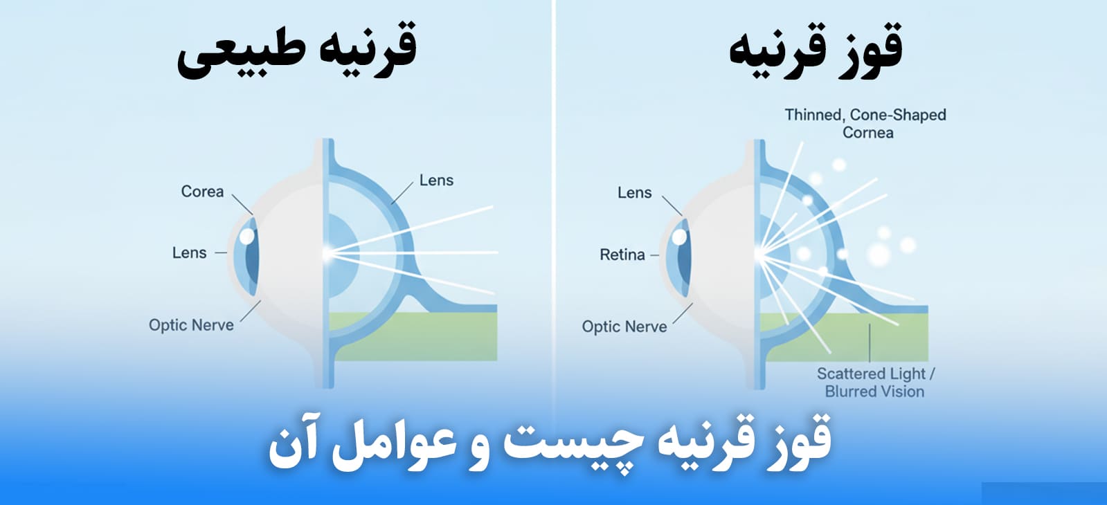 چه چیزی باعث قوز قرنیه می شود؟