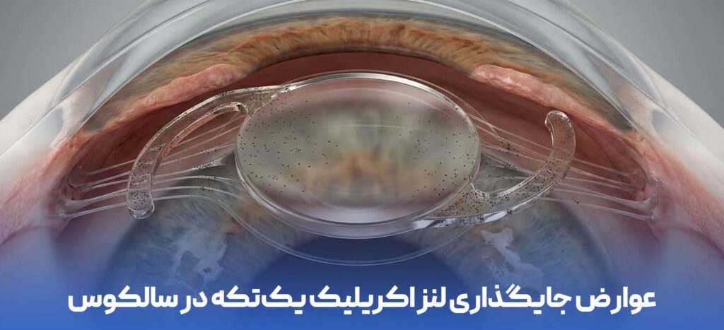 عوارض جایگذاری لنز اکریلیک یکتکه در سالکوس