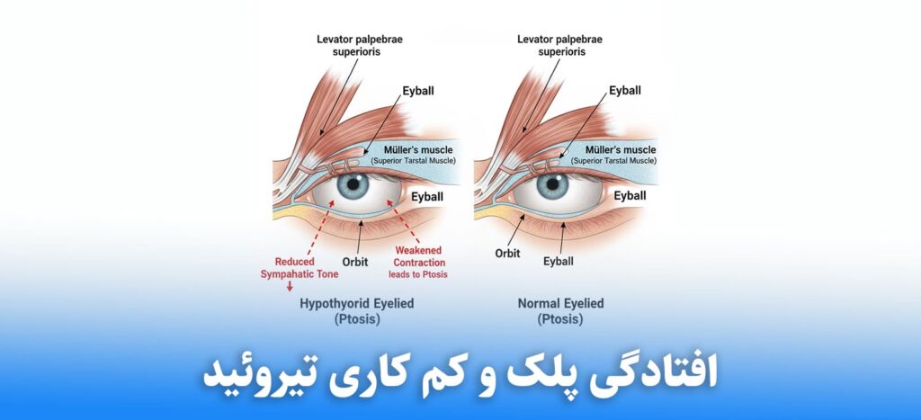 افتادگی پلک و کم کاری تیروئید