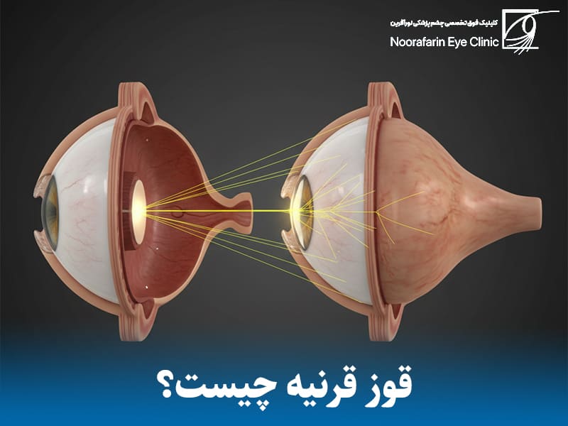 قوز قرنیه (کراتوکونوس) به زبان ساده چیست؟