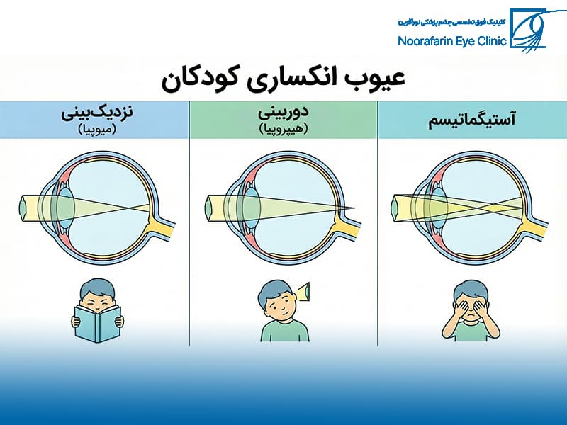 عیوب انکساری (Refractive Errors): تصویر تار