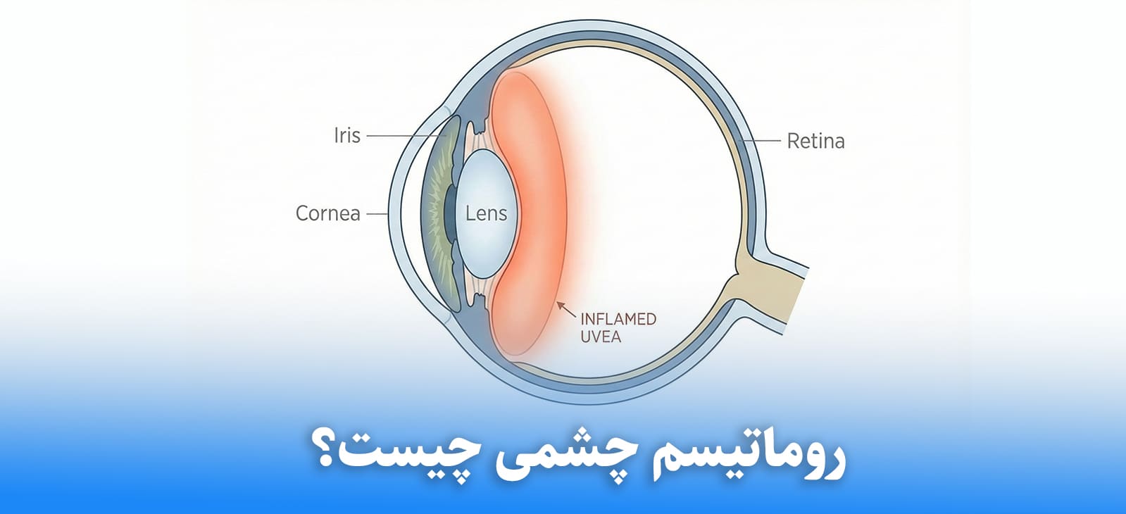 روماتسیم چشمی چیست؟