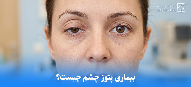 بیماری پتوز چشم چیست؟