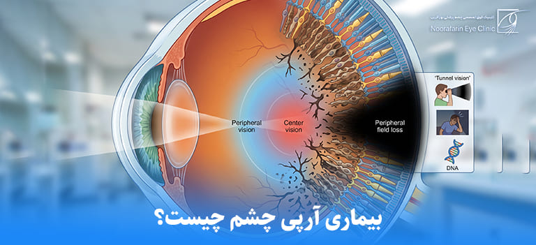 بیماری آر پی چشم چیست