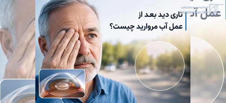 علت تاری دید بعد از عمل آب مروارید چیست