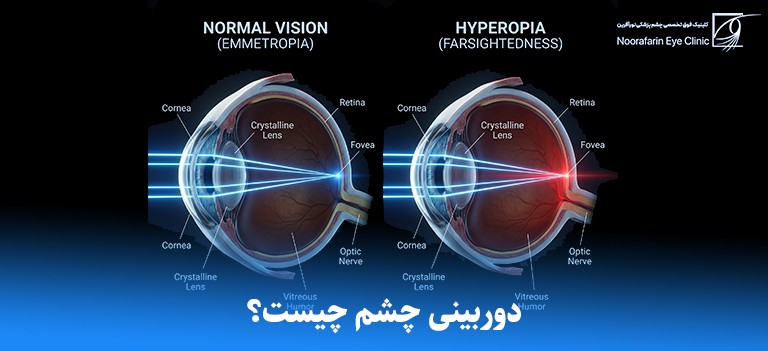 دوربینی چشم چیست؟